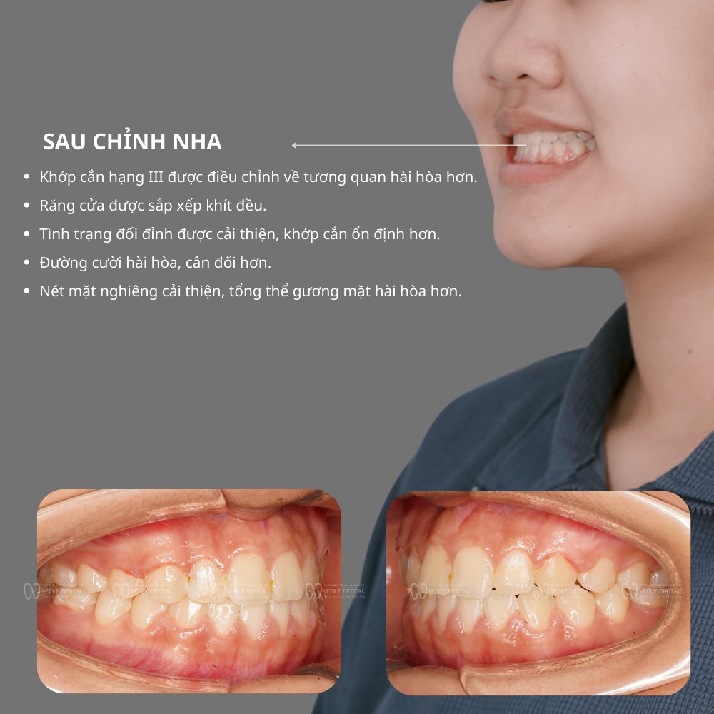 niềng răng bị móm bao nhiêu tiền